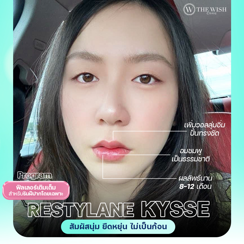 restylane kysse