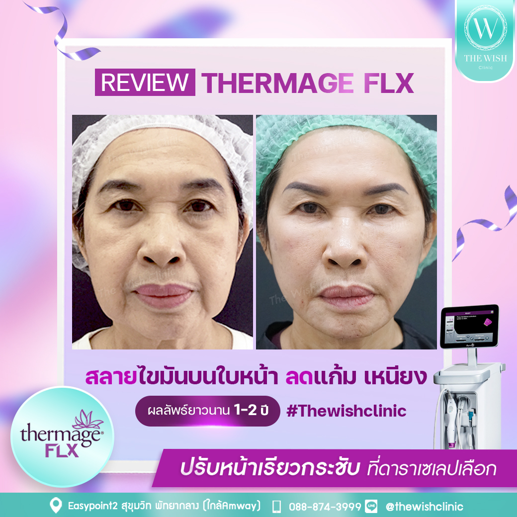 thermage flx