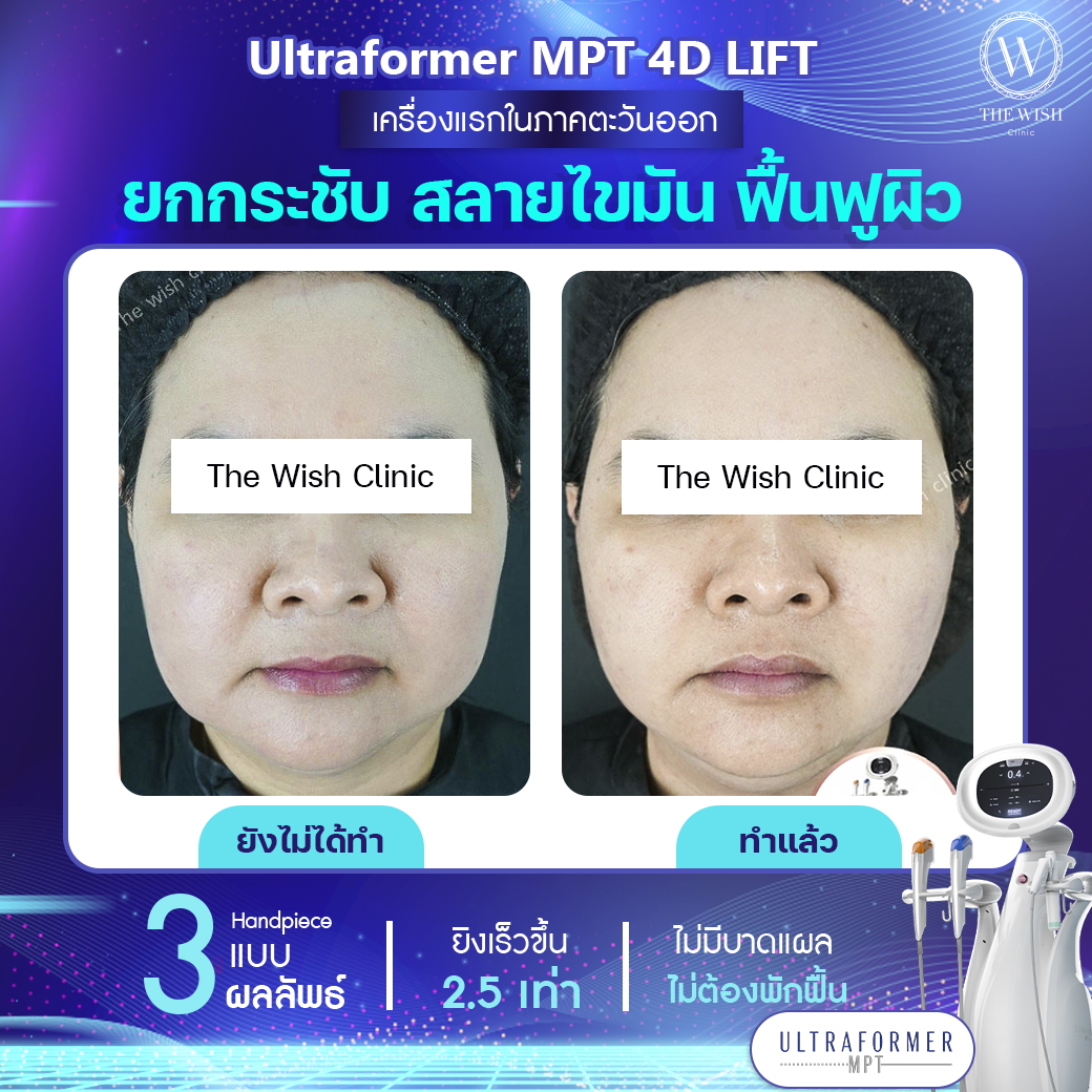 ultraformer mpt