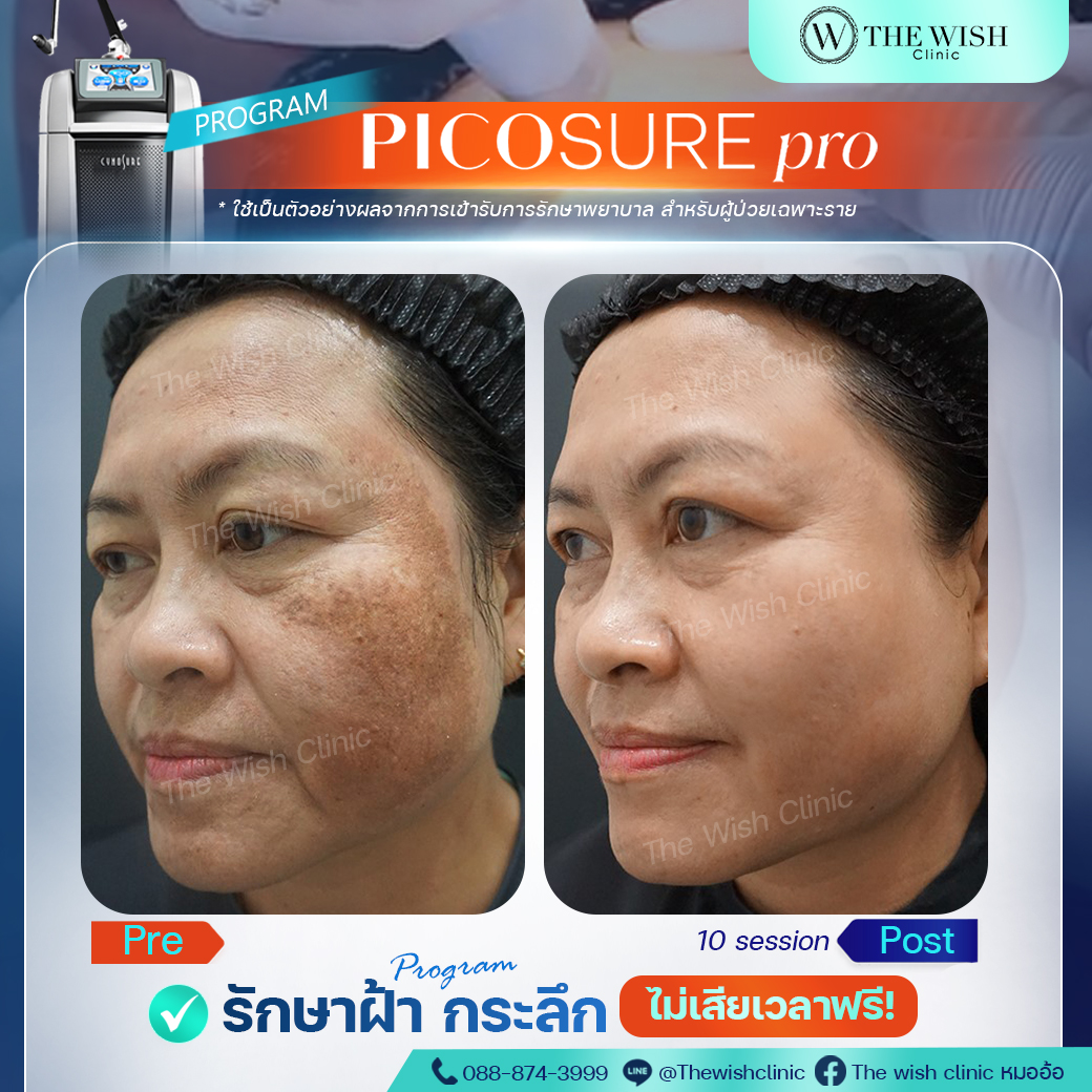 picosure pro