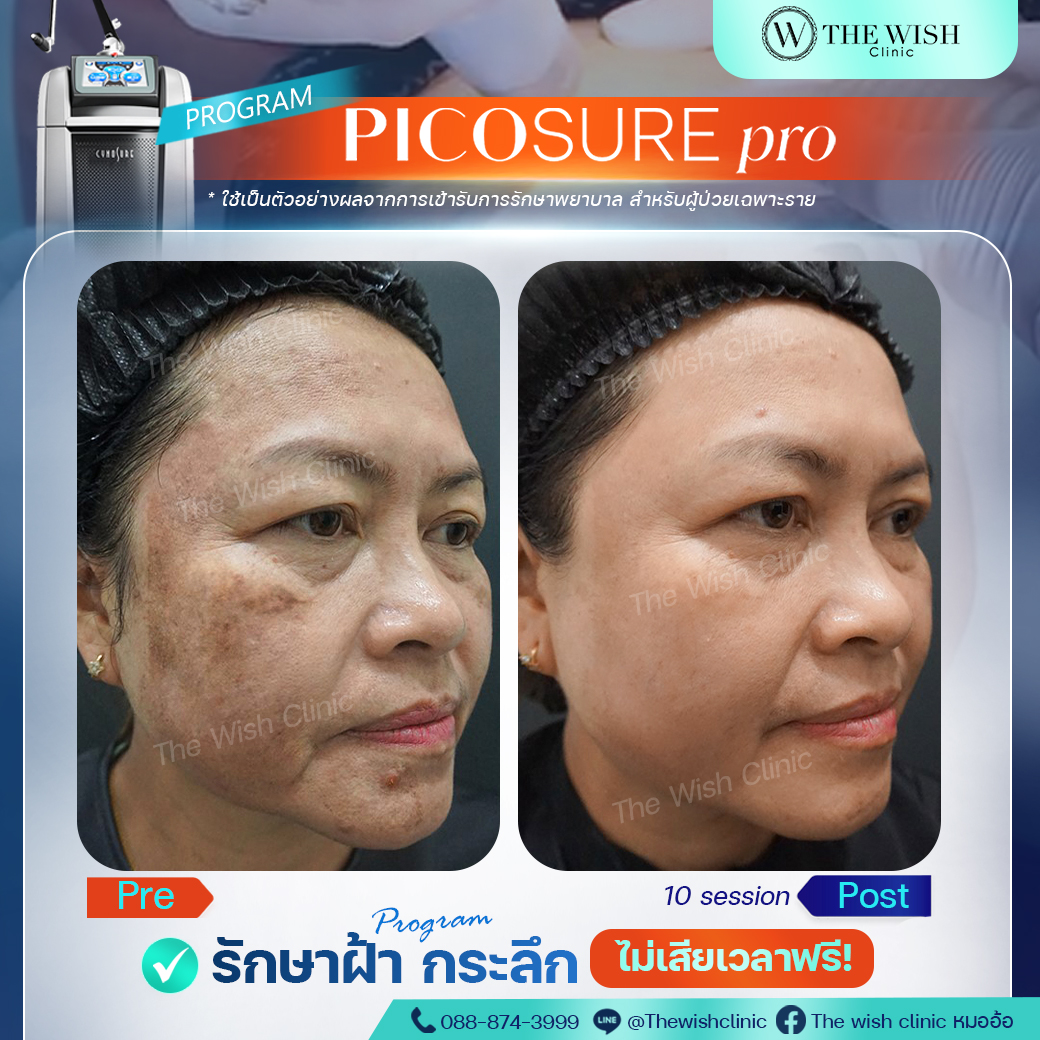 picosure pro