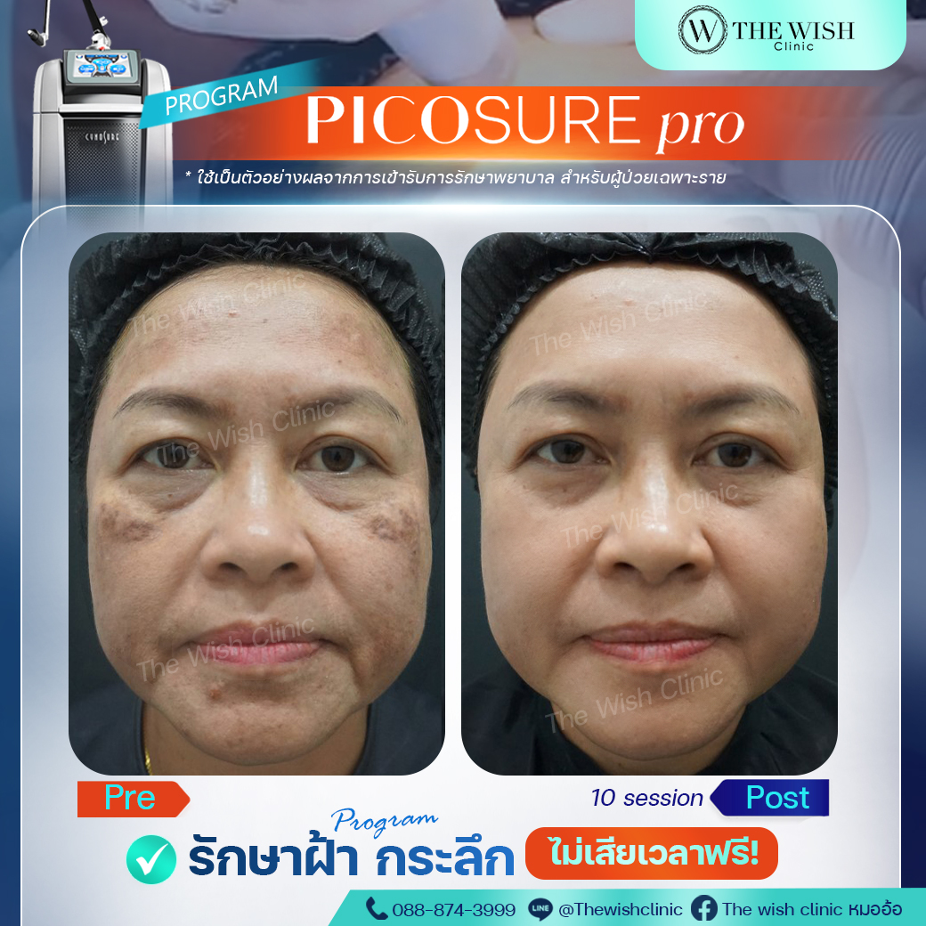 picosure pro