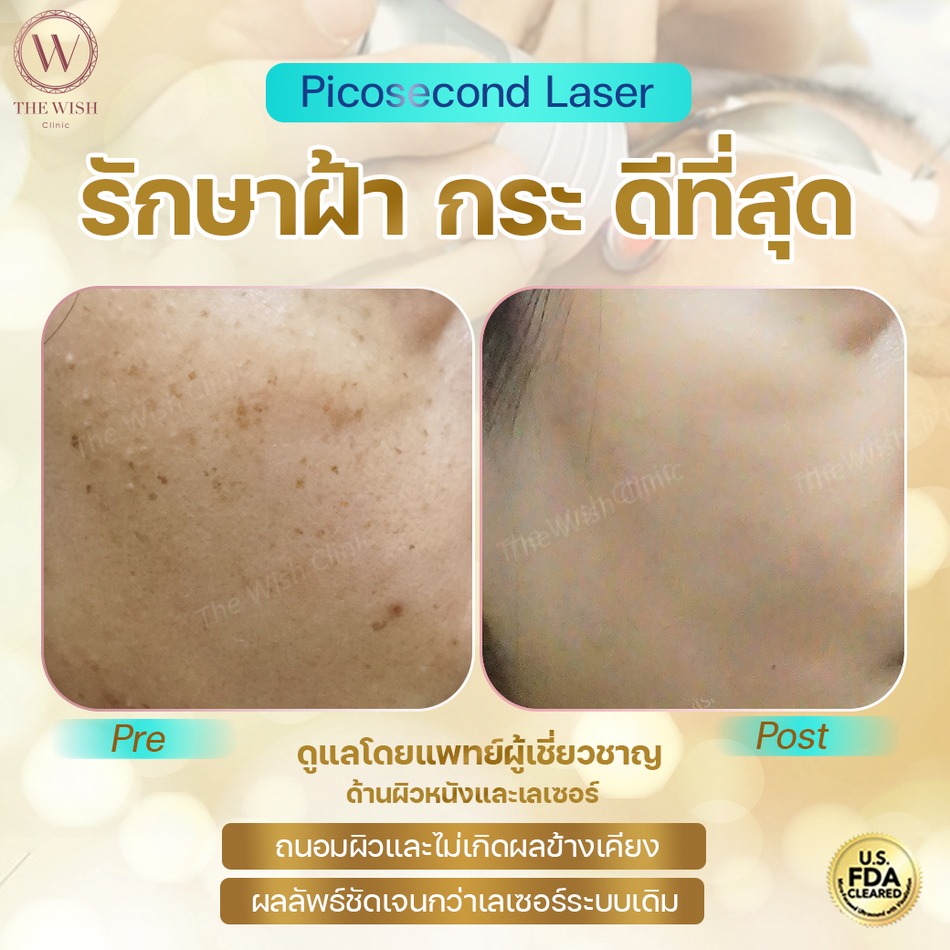 picosecond laser