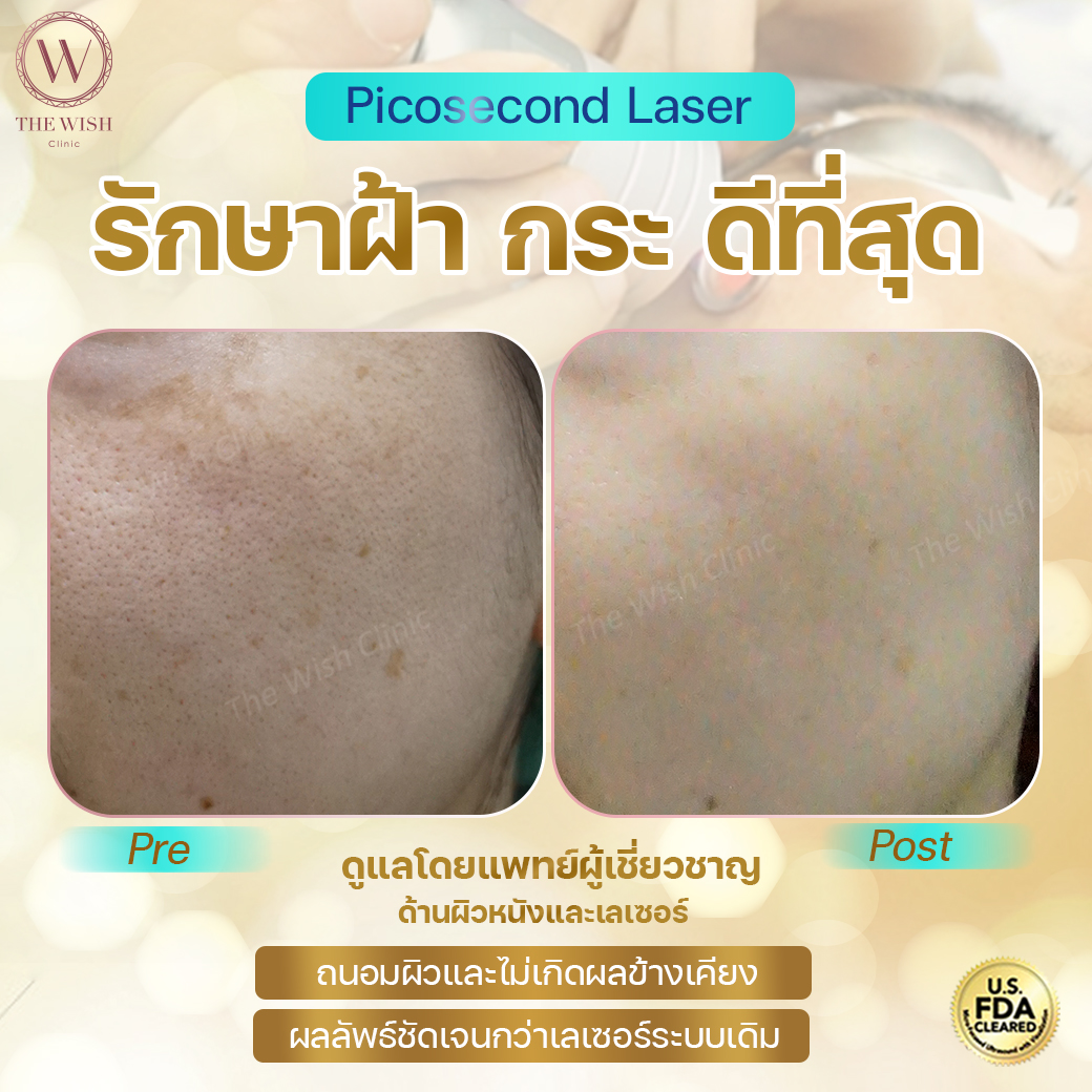 picosecond laser