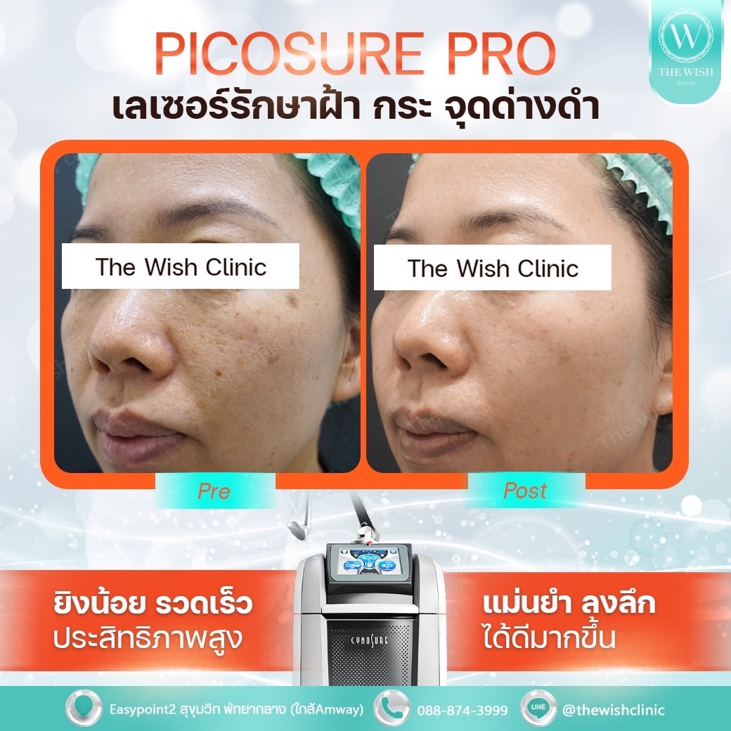 picosure pro