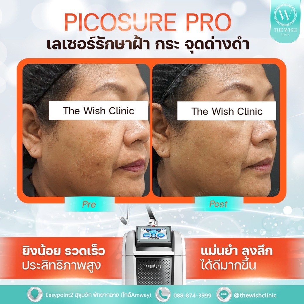 picosure pro