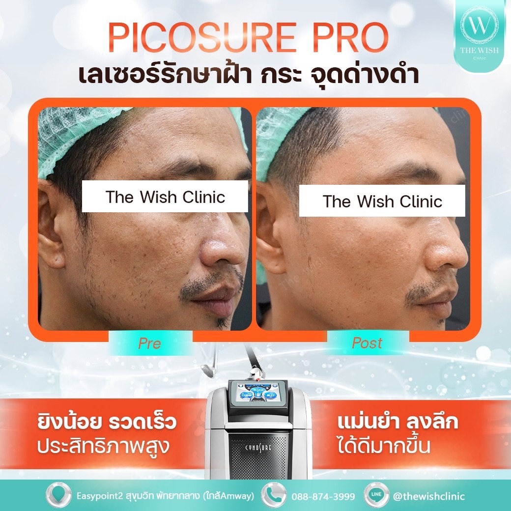 picosure pro