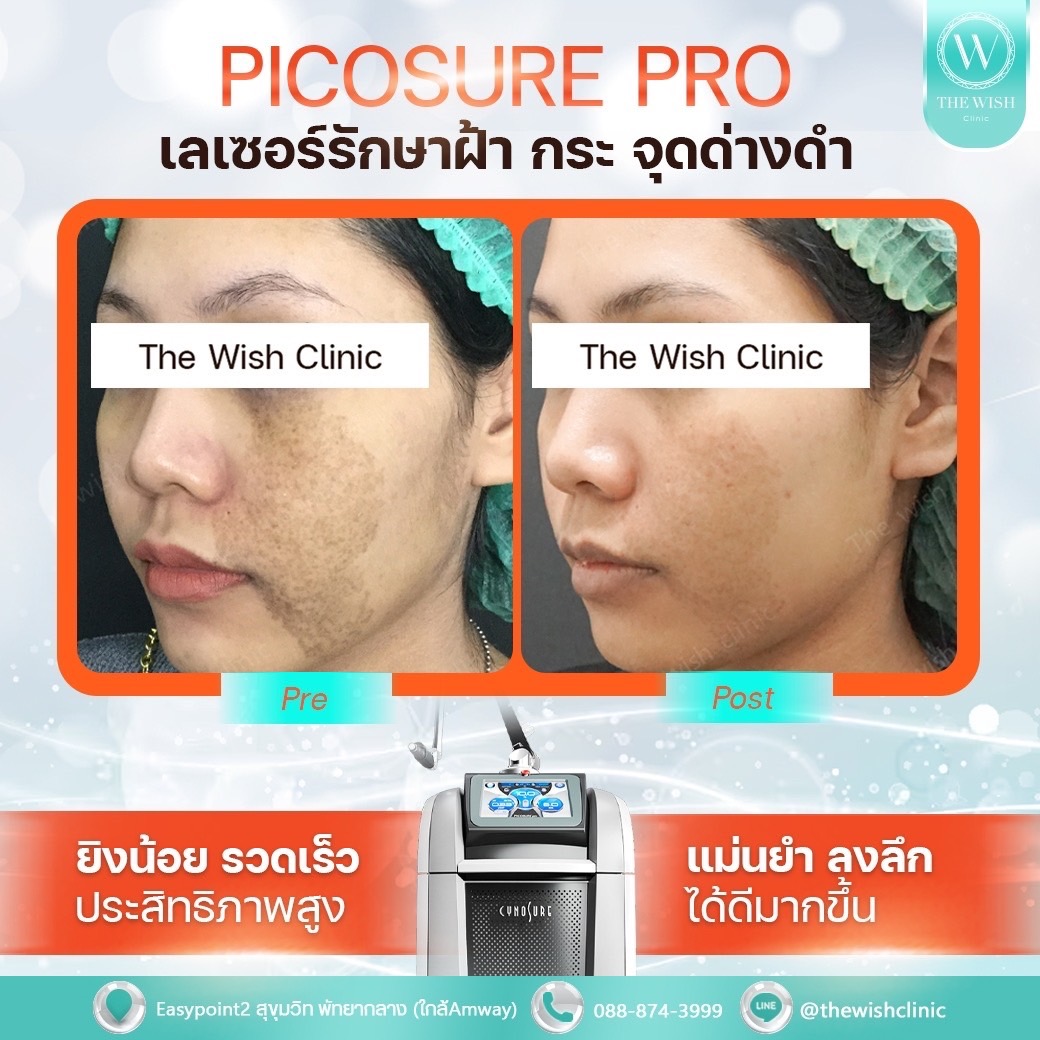 picosure pro