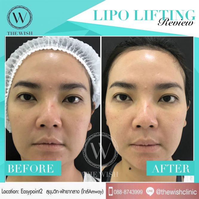 LIPO before after5